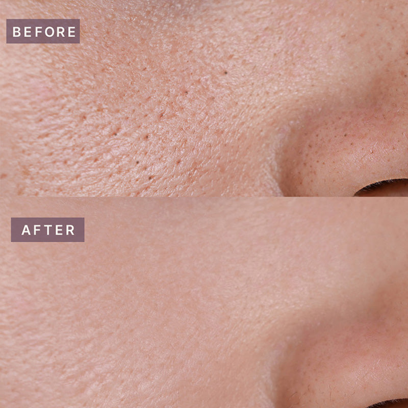 Pot Porenstraffende Podo-Ampulle